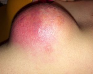 лечение опухолей мягких тканей области левого плечевого сустава