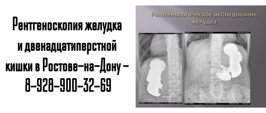 Рентгеноскопия желудка и 12-перстной кишки в Ростове-на-Дону