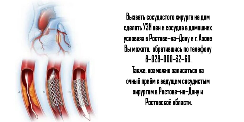 Консультация сосудистого хирурга на дому в Ростове-на-Дону 