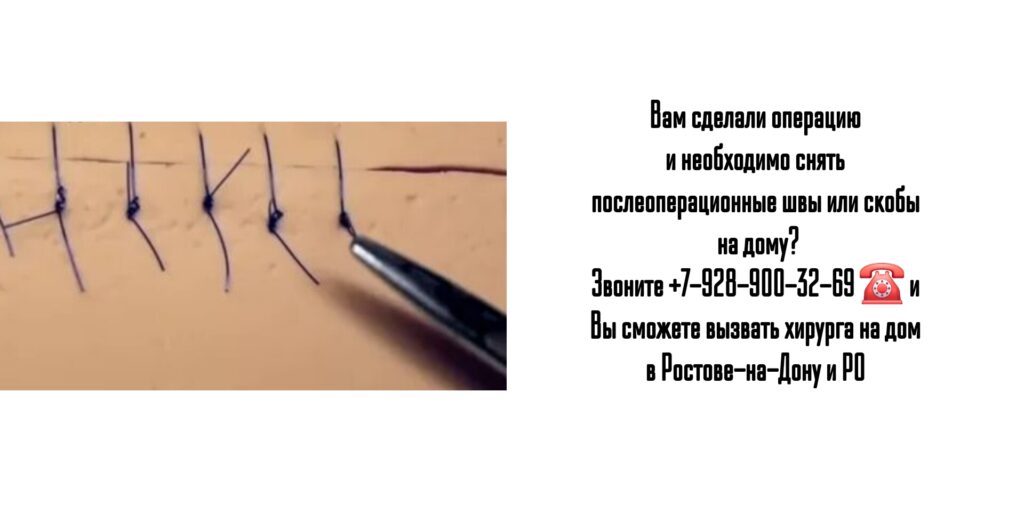 Снятие послеоперационных швов на дому - Ростов-на-Дону и РО 