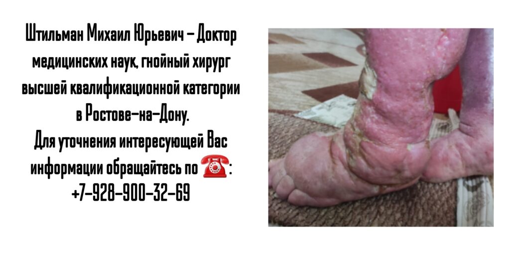 Штильман Михаил Юрьевич Ростов гнойный хирург- диабетическая стопа