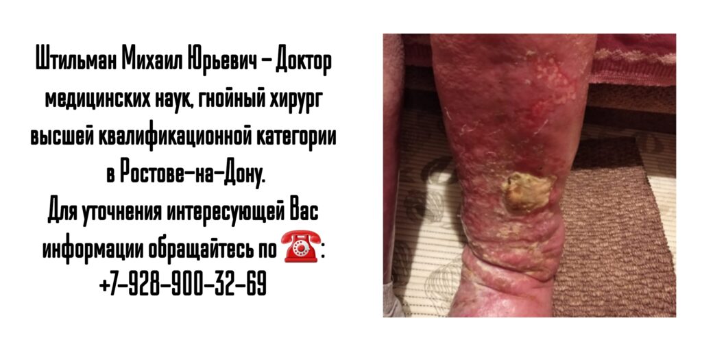 Штильман Михаил Юрьевич Ростов гнойный хирург- диабетическая стопа