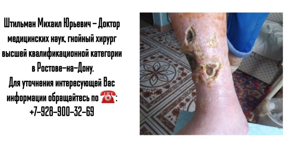 Штильман Михаил Юрьевич Ростов гнойный хирург- диабетическая стопа