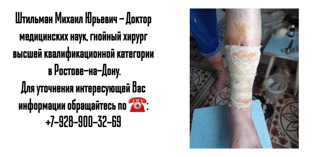Штильман Михаил Юрьевич Ростов гнойный хирург- диабетическая стопа