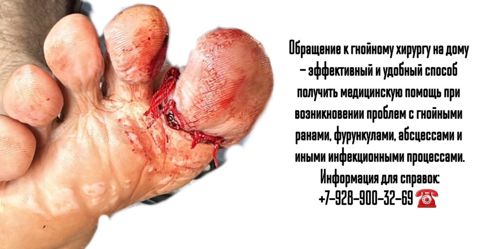 Вызов на дом гнойного хирурга в Ростове-на-Дону 
