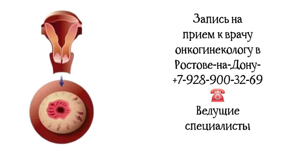 Онкогинеколог в Ростове-на-Дону - важная роль в диагностике и лечении рака