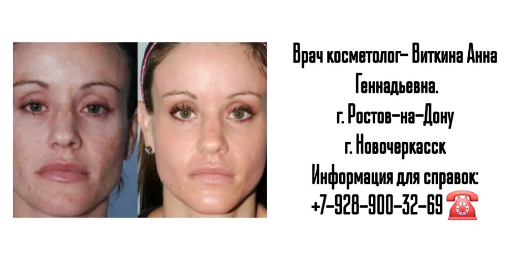 Виткина Анна Геннадьевна - лазерная шлифовка лица