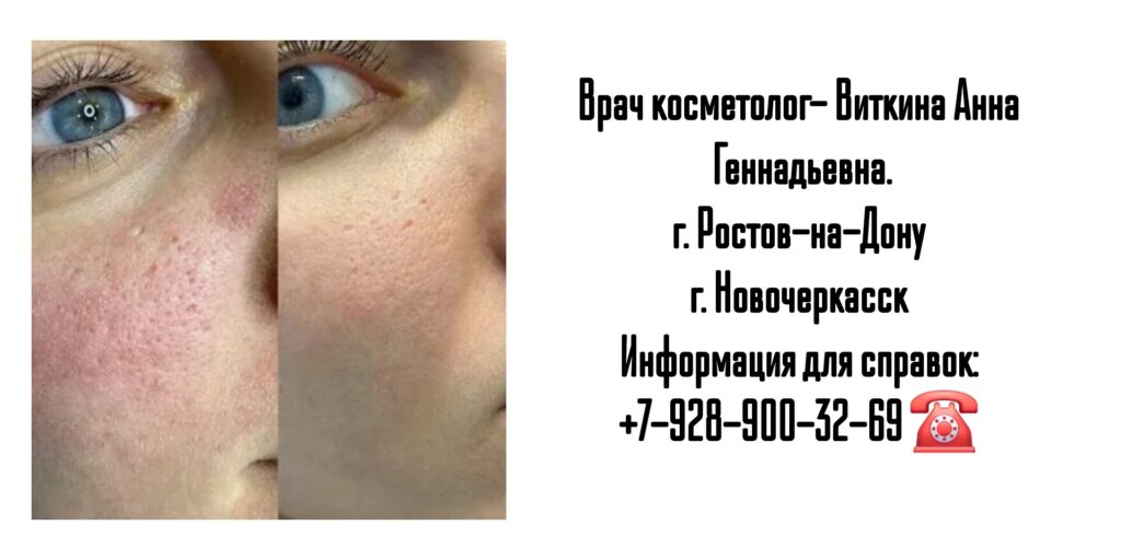 Виткина Анна Геннадьевна - лазерная шлифовка лица