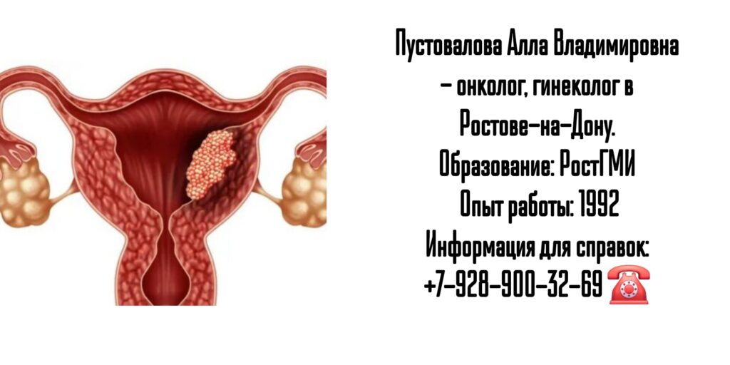 Пустовалова Алла Владимировна - онколог гинеколог Ростов