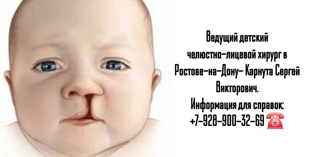 Карнута Сергей Викторович - челюстно-лицевой хирург детский Ростов- Расщелина верхнего мягкого неба