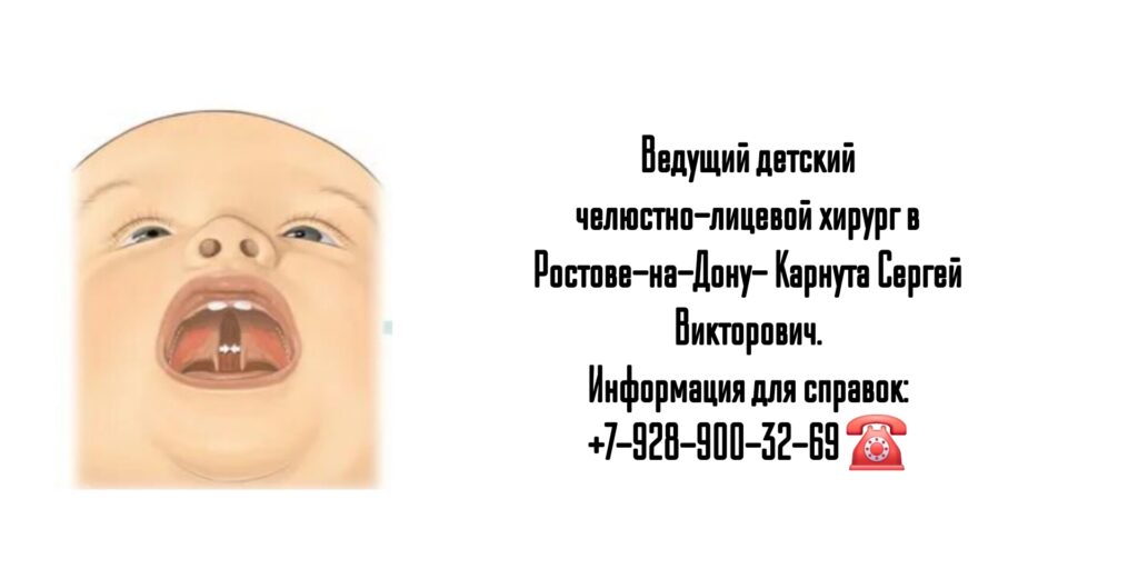 Карнута Сергей Викторович - челюстно-лицевой хирург детский Ростов- Расщелина верхнего мягкого неба
