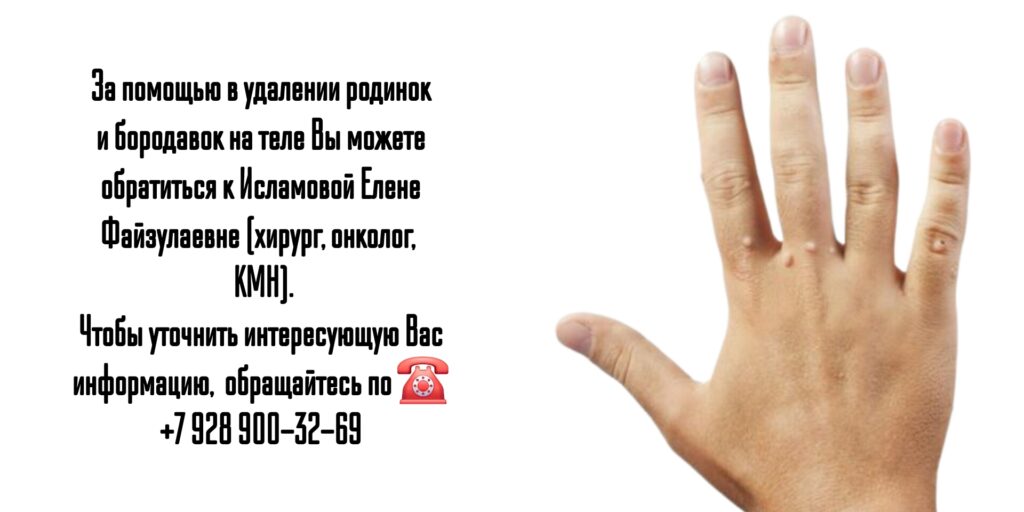 Удаление бородавок и родинок на теле Ростов-на-Дону