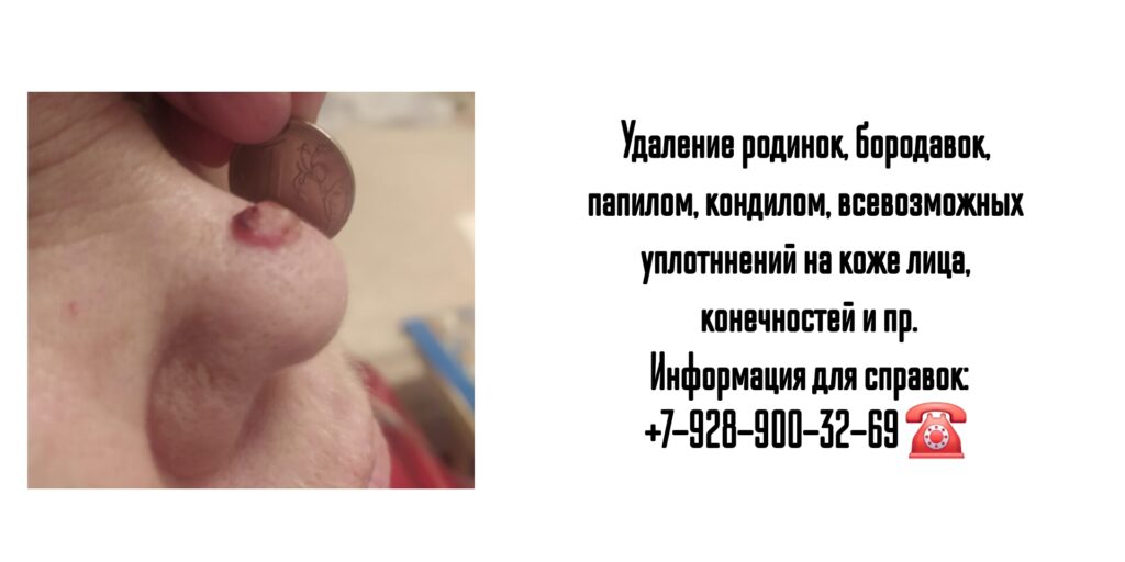 Удаление кожных новообразований в Ростове-на-Дону- Ведущие специалисты 