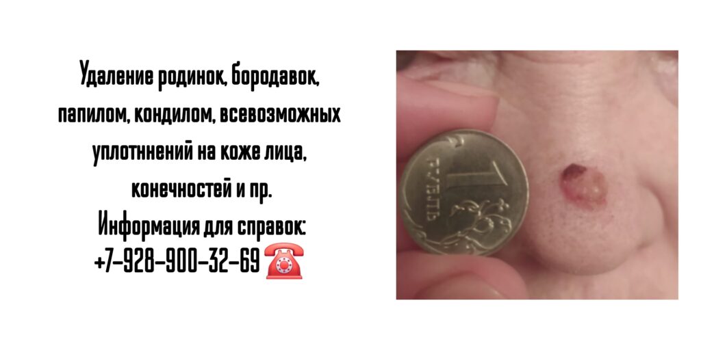 Удаление кожных новообразований в Ростове-на-Дону- Ведущие специалисты 