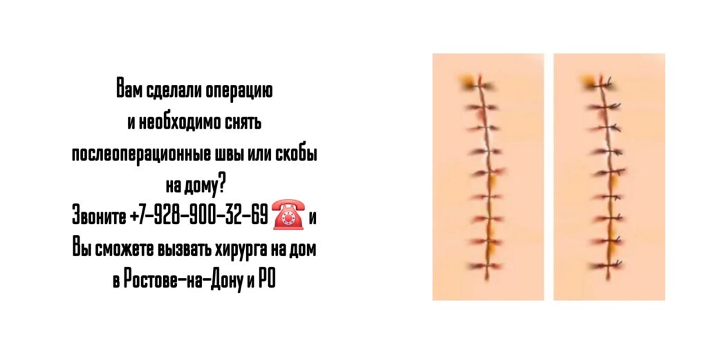 Снятие послеоперационных швов на дому - Ростов-на-Дону и РО 
