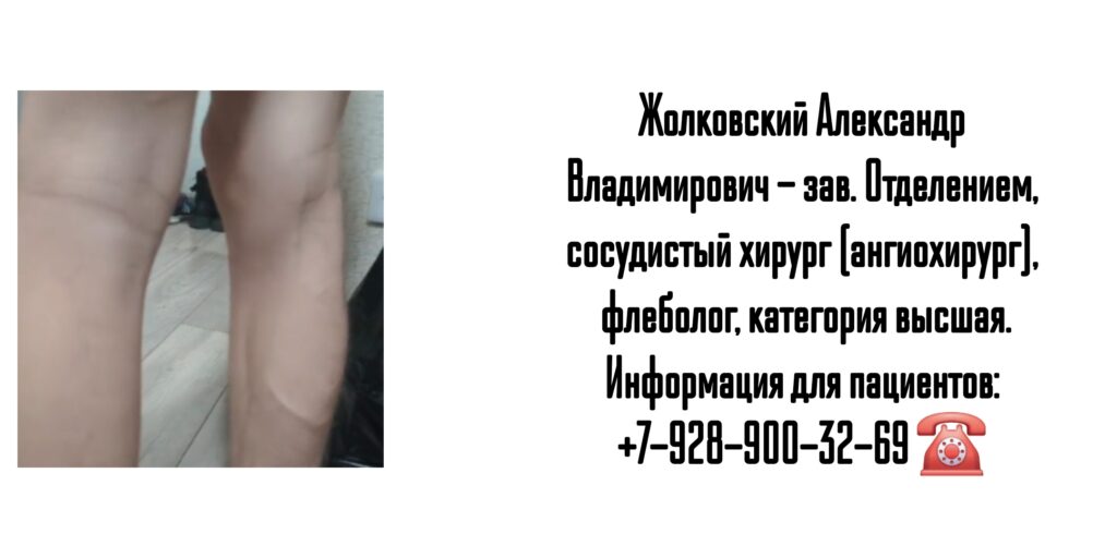 Сосудистый хирург Ростов - Жолковский Александр Владимирович 