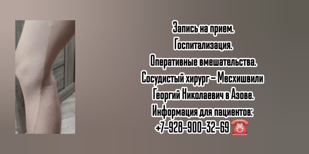 Месхишвили Георгий Николаевич- Сосудистый хирург Азов 