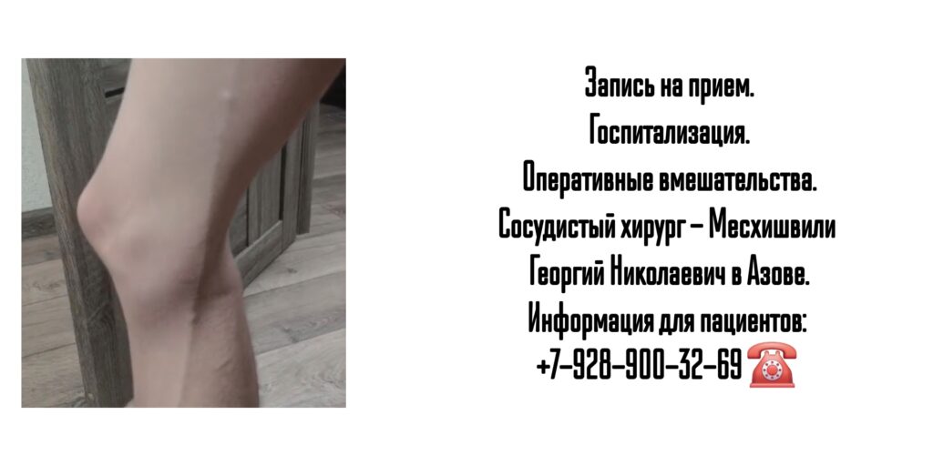 Месхишвили Георгий Николаевич- Сосудистый хирург Азов 