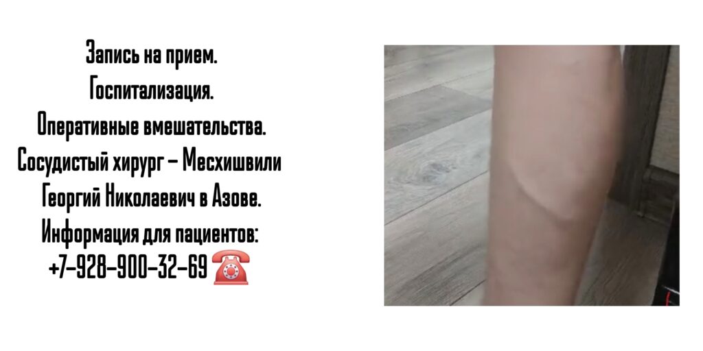 Месхишвили Георгий Николаевич- Сосудистый хирург Азов 