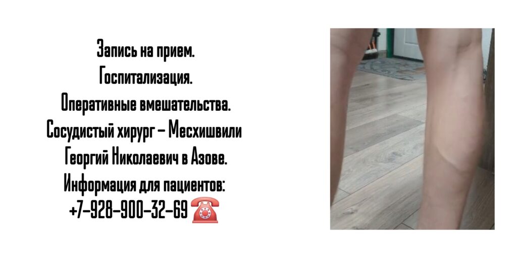 Месхишвили Георгий Николаевич- Сосудистый хирург Азов 