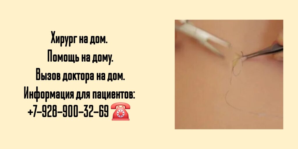 Снять швы на дому в Ростове-на-Дону - после операции 