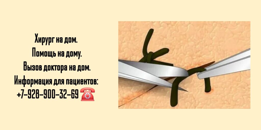 Снять швы на дому в Ростове-на-Дону - после операции 