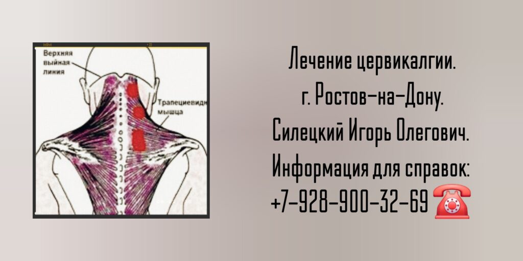 Цервикалгия - лечение в Ростове-на-Дону - Силецкий Игорь Олегович 