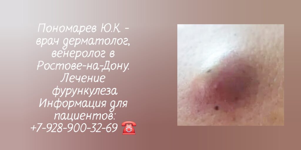 Лечение фурункулеза в Ростове-на-Дону- Пономарев Юрий Константинович