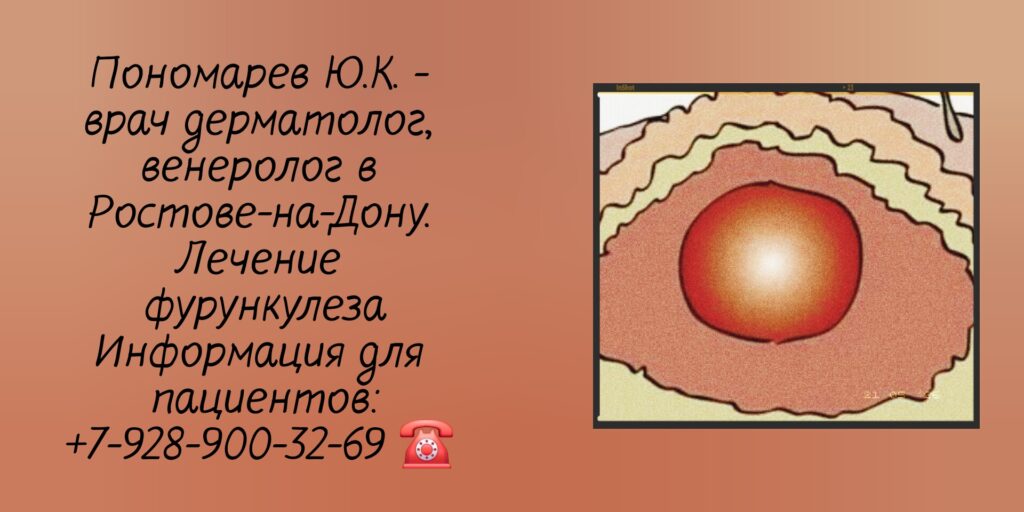 Лечение фурункулеза в Ростове-на-Дону- Пономарев Юрий Константинович